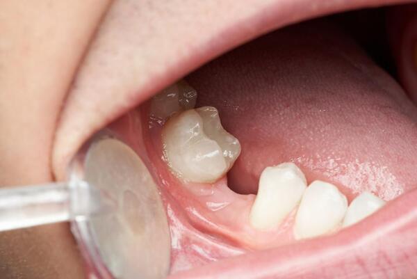 rụng răng hàm dưới